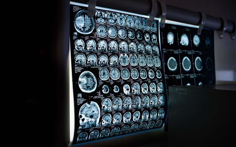 Более 100 000 снимков МРТ были использованы для разработки первой диаграммы, измеряющей нормальные изменения мозга в течение жизни человека.